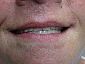 Mouth After Treatment