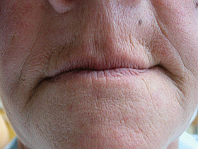 Mouth Before Treatment