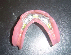 Bottom View Of Removable Denture