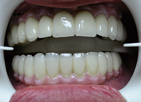 Dental Bridges Screwed Onto Implants