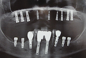 9 Camlog & 4 Branemark Dental Implants Placed