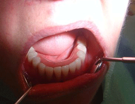 Denture Anchored On Bar Supported By Implants