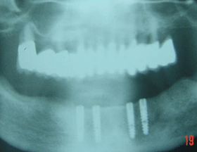 4 Camlog Dental Implants Placed In The Lower Jaw