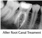 Tooth Before Root Canal Treatment