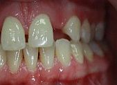 Gap Before Dental Bridge