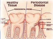 Gum Disease