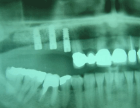 3 Camlog Dental Implants Placed Following Sinus Lift