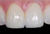 Dental Crowns_after
