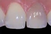 Dental Crowns_before