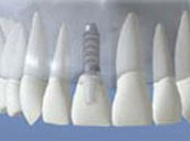 Dental-Implants-after