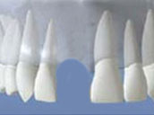Dental-Implants-before