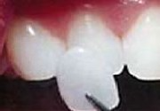 Porcelain Veneers (1)