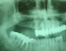 imgi_15_area-for-bone-grafting