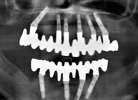imgi_22_opg-all-on-6-4-implants