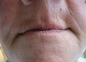 imgi_24_before-treatment