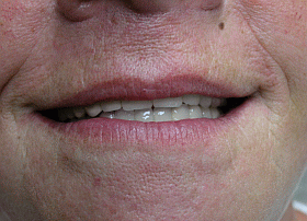 imgi_25_after-treatment