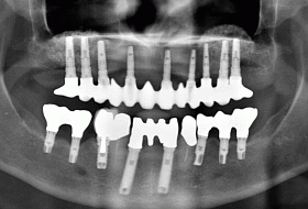 imgi_28_opg-9Camlog-4Branemark-with-bridges