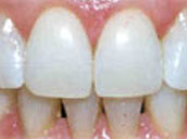 teeth-whitening-after