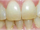 teeth-whitening-before