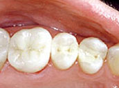 tooth-filling-after
