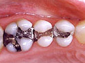 tooth-filling-before